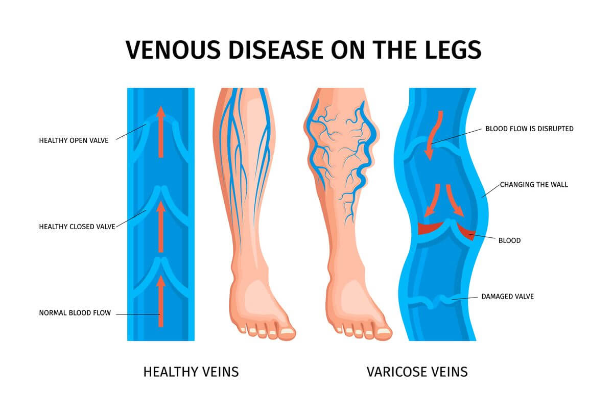 Venous insufficiency is a disease process which can affect all age groups.