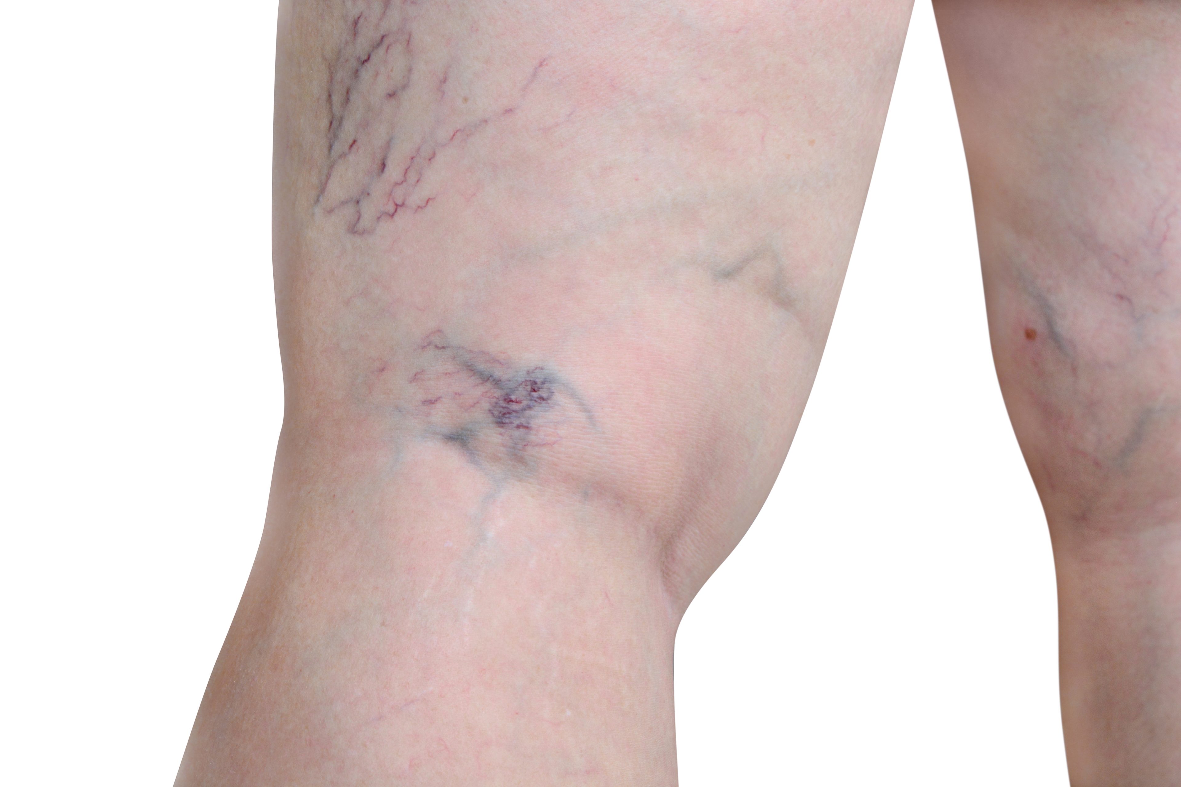 image of venous insufficiency on person's knee